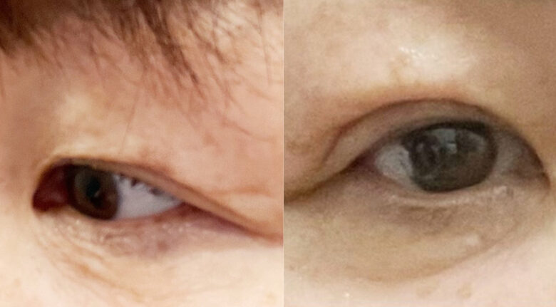 手術前の北斗晶さん(左)と手術後の北斗晶さん(右)
